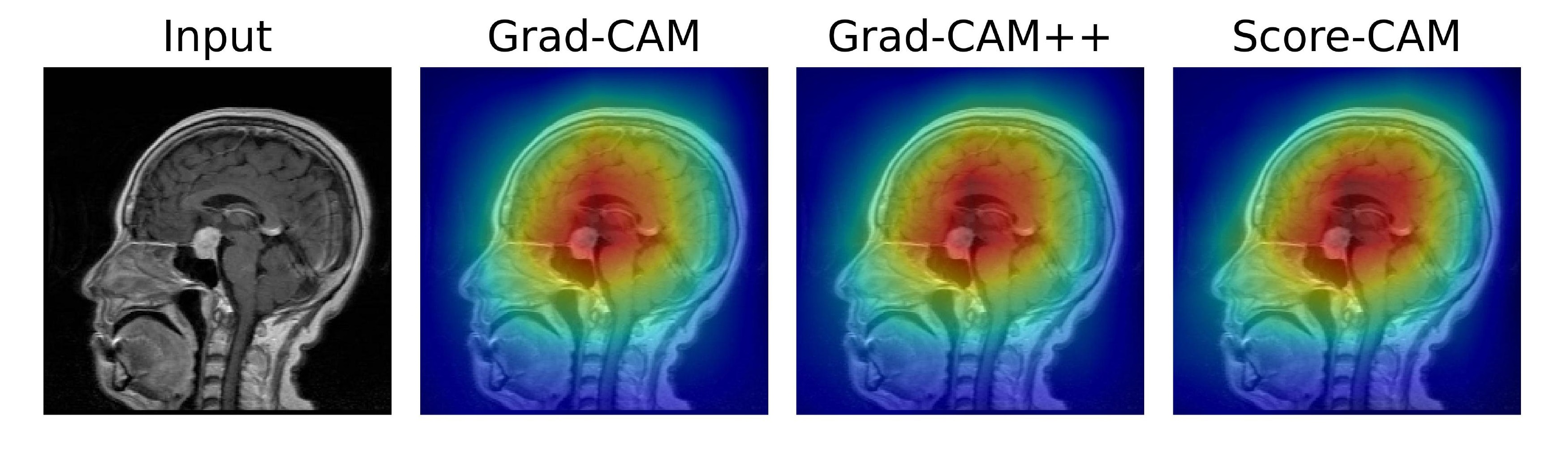 Pituitary